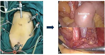 The Transumbilical Laparoendoscopic Single-Site Extraperitoneal Approach for Pelvic and Para-Aortic Lymphadenectomy: A Technique Note and Feasibility Study